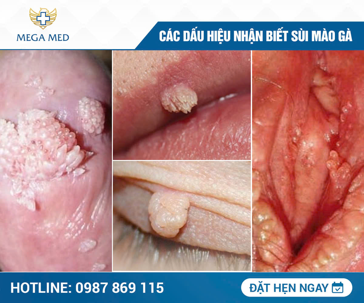 Dấu hiệu bệnh sùi mào gà